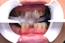 Tandbehandling i udlandet