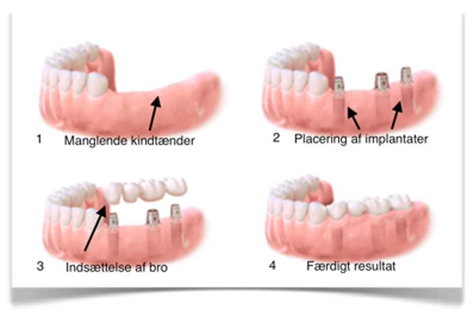 Fastsiddende tandprotese